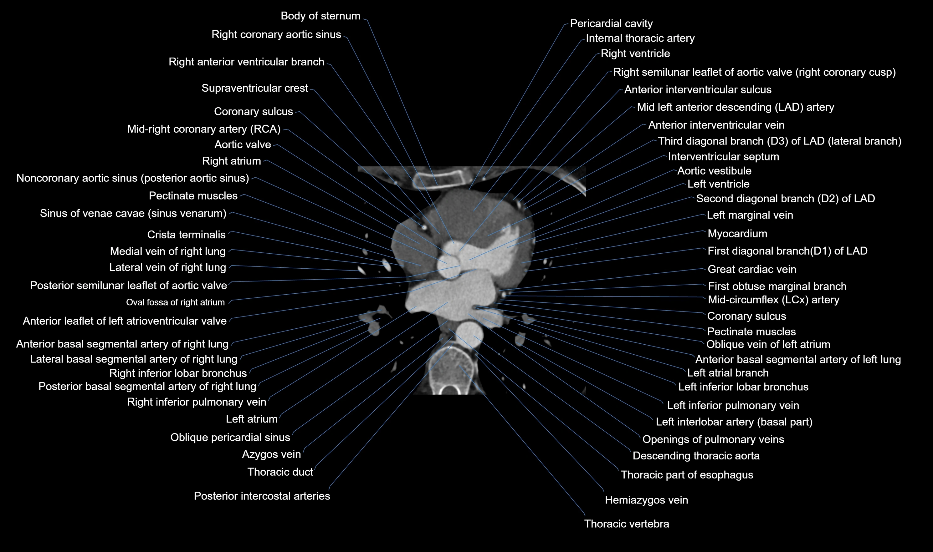 CT heart (coronary angiogram) axial view cross sectional anatomy labelled radiology image-00032.webp